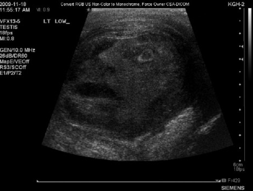 The face of testicular pain